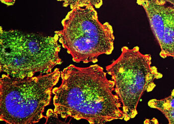 Melanoma con metastasi cerebrali, a 10 anni dalla diagnosi l’immunoterapia continua a funzionare