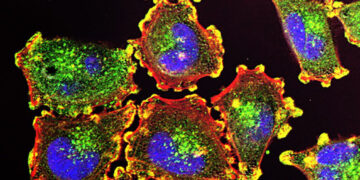 Melanoma con metastasi cerebrali, a 10 anni dalla diagnosi l’immunoterapia continua a funzionare