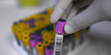 Tubercolosi, verso test sangue ultra-sensibile per diagnosi infezione latente o iniziale
